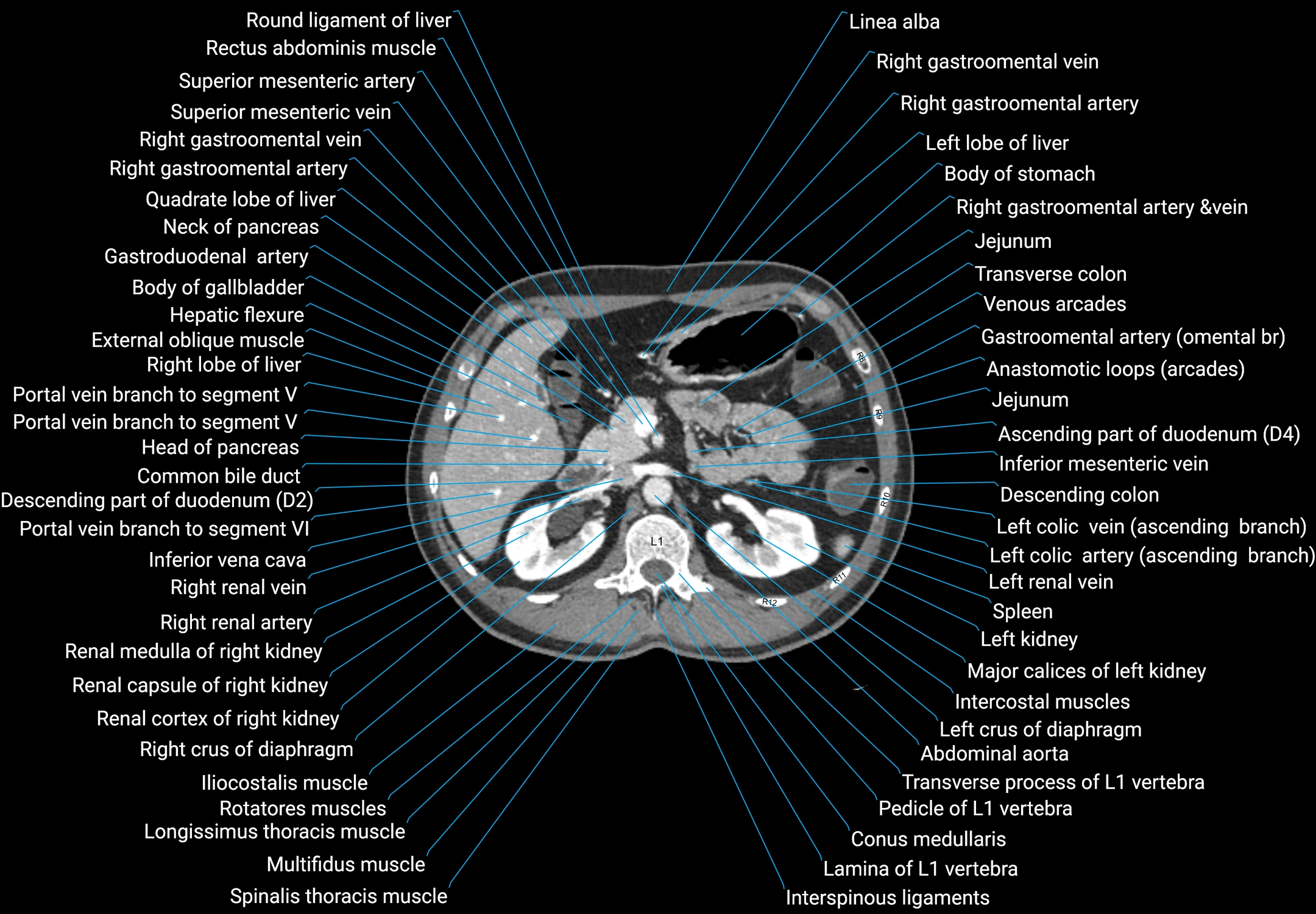 CT male pelvis axial cross sectional anatomy labelled radiology image -00057.webp